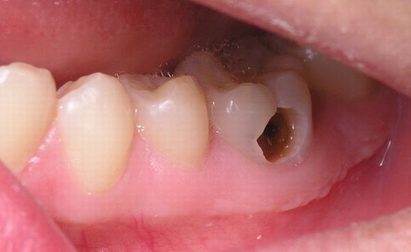 Konya Diş Çürüğü Tedavisi