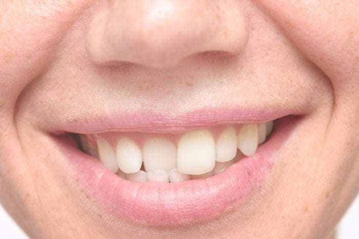 Konya Çarpık & Yamuk Diş Tedavisi | Ortodonti