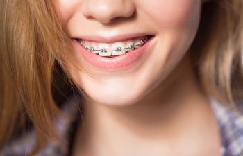 Konya Diş Teli & Şeffaf Diş Teli Tedavisi